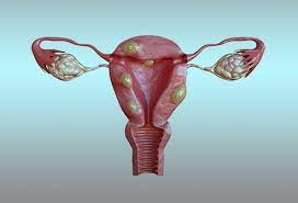 If you have symptoms of uterine fibroids then your doctor may suggest these tests: Adenomyosis Vs Uterine Fibroids Differences In Symptoms Treatment