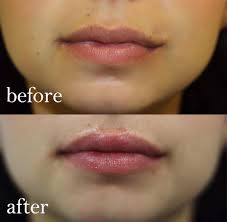 The incubation period is the time between the exposure to a virus or bacteria and the appearance of symptoms. I Had Lip Fillers And This Is What Happened It S Not What You Think Healthista