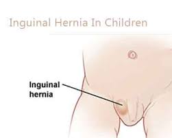 Image result for Inguinal hernia child