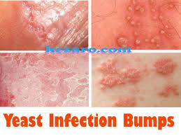 This Can Cause Many Health Problems In Your Body Like Yeast Infection Bumps Candida In B Yeast Infection Treatment Yeast Infection Cure Yeast Infection Causes