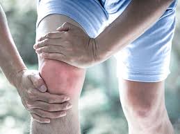 Image result for gout symptoms knee