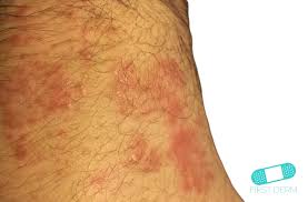 While there's no cure for it, there. Itchy Red Bumps Common Causes