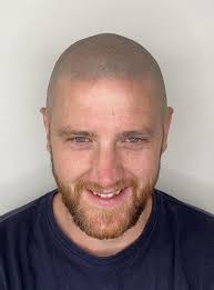 Scalp Micropigmentation After Hair Transplant