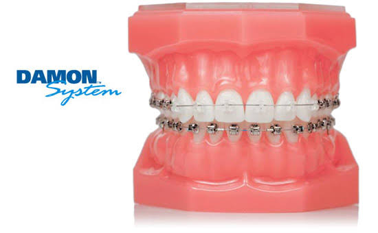 Self Ligating Braces product image