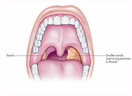 Tonsillitis treatment