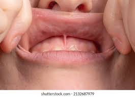 Image result for Labial mucosa
