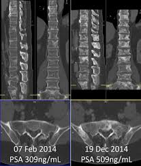 But hearing the words can still be scary. Rationale For Modernising Imaging In Advanced Prostate Cancer Sciencedirect
