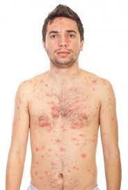 Intrebari si raspunsuri pete rosii pe corp. Bube RoÈ™ii Pe Corp Romedic