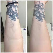For tattoo removal, repare skincare recommends wiping down the area with the included alcohol prep pads. One Year Difference I Only Had One Very Small Session In That Time On That Darker Stubborn Part The Rest Has All Faded On Its Own With Time And A Little Help