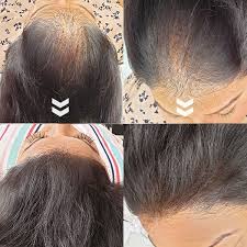 Discover the best asian hairstyles for your texture. Our Clients It Before After Scalp Micropigmentation For Women