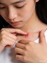 擠暗瘡感染高燒40℃ 深圳女就醫確診「2型糖尿病」 醫指1飲食習慣惹禍