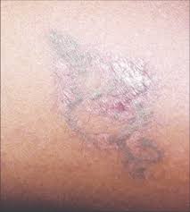 If you are prone to keloids (a. R20 Method Scarring Download Scientific Diagram