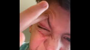 My Dog Scratch My Eye Youtube
