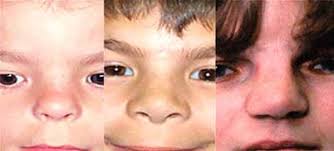 Another common manifestation is the short, flattened bridge of the nose of the child. Jacobsen Syndrome Medlineplus Genetics