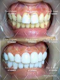 Teeth whitening lighten teeth colour, help to remove stains and discolouration & improve how your teeth look. German Nano Crystal Whitening Teeth Treatment Health Beauty Fitness For Sale In Setia Alam Selangor Sheryna Com My Mobile 768679