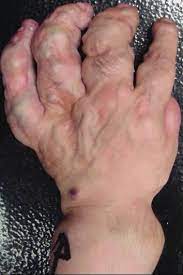 Enchondromatosis Types Presentation And Differentiation Bone And Spine