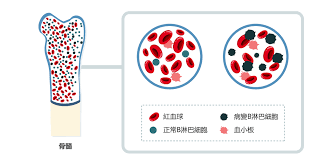 認識CLL – CLL 慢性淋巴細胞白血病