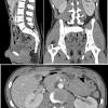 I performed an scope examination of her esophagus and confronted a huge cancer occupying the lower portion of her esophagus. 1