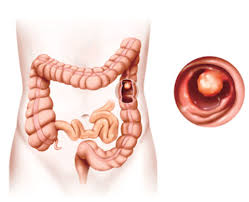 Treten größere blutungen, bauchschmerzen oder fieber auf, muss sofort ein arzt aufgesucht werden. Warum