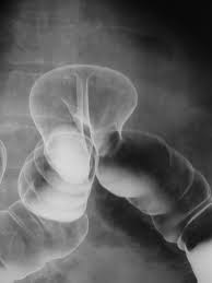 Unilateral femoral hernia, without obstruction or gangrene, not specified as recurrent unilateral femoral hernia, without obstruction or gangrene, recurrent. Hernie Wikiwand