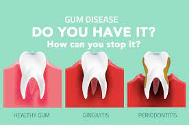 Why Do Gums Bleed And How You Can Cure Your Bleeding Gums (All You Need To  Know)