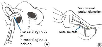 Surgical Technique Of Indirect Open Reduction Ior Through