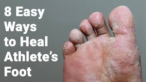 8 Easy Ways To Heal Athlete S Foot
