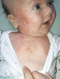 Learn how to tell whether those itchy, red patches on your child's skin are eczema, how common eczema is in children, and how to treat eczema. Mum Whose Baby Had Eczema So Severe People Thought He D Been Burned Reveals It S Been Cured With Life Changing Body Wash