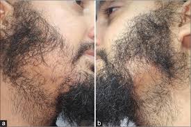 Image result for Beard Dermatitis