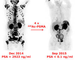 If breast cancer is diagnosed at an early enough stage, it's treatable. Nuclear Medicine Study On Targeted Alpha Therapy Of Prostate Cancer With 225actinium Psma617 Receives Eanm Marie Curie Award 2017 Eu Science Hub