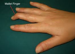 Heidi said just moving around is helping her to get back to normal. Mallet Finger