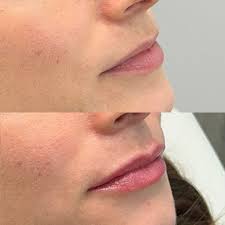 Lip Fillers