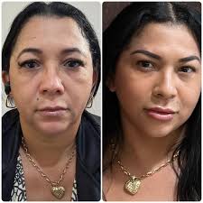 ✨ Autoestima renovada, beleza realçada! ✨ Com a combinação da lipo de  papada e preenchimento facial, conseguimos devolver à face um contorno  jovem, traços harmônicos e aquele brilho de confiança que vem