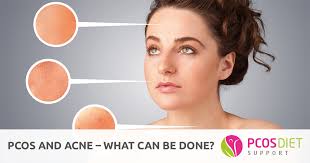 Pcos And Acne What Can Be Done Pcos Diet Support