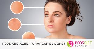 pcos and acne what can be done pcos diet support