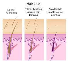 It can increase the look and health of existing hair, so taking it can help strengthen the hair you currently have, explains hair loss coach hannah maruyama. Male Pattern Baldness Could See First New Treatment In Over 10 Years From Cassiopea