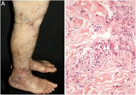 Maybe you would like to learn more about one of these? Update On Vasculitis Overview And Relevant Dermatological Aspects For The Clinical And Histopathological Diagnosis Part Ii Sciencedirect