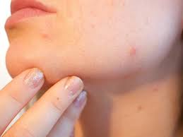 Intip di sini beberapa cara menghilangkan jerawat secara alami yang murah dan mudah diterapkan! 7 Cara Menghilangkan Jerawat Batu Yang Membandel Dengan Bahan Alami Ampuh Dan Tanpa Efek Samping Health Liputan6 Com