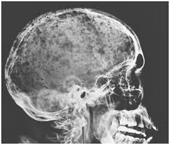 Multiple myeloma (mm) is a debilitating malignancy that is part of a spectrum of diseases ranging from monoclonal gammopathy of unknown significance (mgus) to plasma cell leukemia. Raindrop Skull A Skeletal Survey Showed Diffuse Grepmed