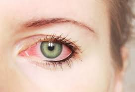 Occhio arrossato e secco in portatore di lenti a contatto