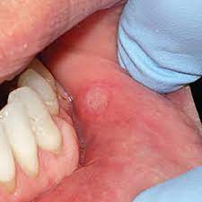 You May Need Your Dentist S Help Easing The Pain Of Severe Canker Sores Demarco Family Dental