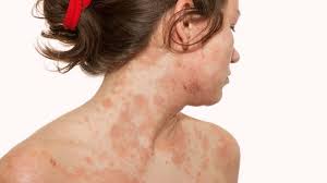 Image result for skin rash similar to scabies