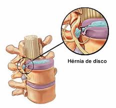 Resultado de imagem para inicio da degeneração do disco intervertebral