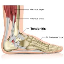 Hamstring tendonitis occurs when the soft tissues that connect the muscles of the back thigh to the pelvis, knee, and lower legs become inflamed. What Is Peroneal Tendonitis Cincinnati Foot Ankle Care