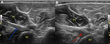 Image result for Biceps Tendon Injection