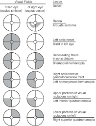 Image result for Visual Field Deficit