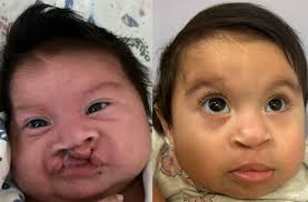 Plastic & Reconstructive Surgery at Johns Hopkins All Children's Hospital