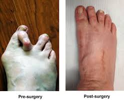 Image result for toe amputation