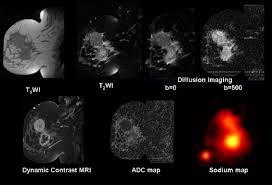 Mri offers a very detailed picture of breast tissue, but it can also turn up a lot of false positives —suspicious results that prove, later, not to be cancer. Multiparametric Magnetic Resonance Imaging Of Breast Cancer Journal Of The American College Of Radiology