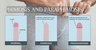 Image result for paraphimosis